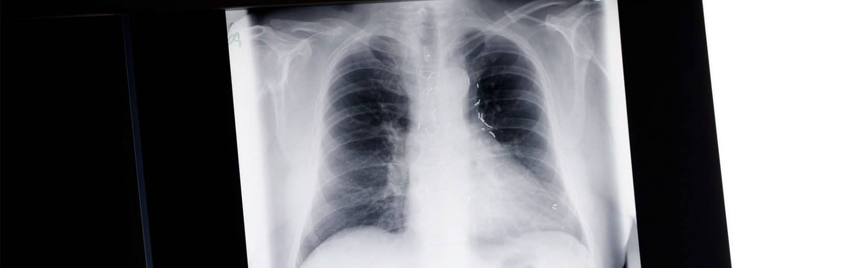 Röntgenbild Lunge