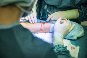Gefäßchirurgie: Shuntoperation