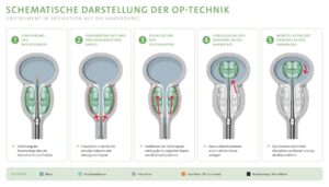 Schematische Darstellung der OP-Technik ThuLEP, die zeigt, wie das Resektops über die Harnröhre in die Prostata eingeführt wird, um das enukleierte Adenom in die Harnröhre zu verlagern. Dort wird es mittels Morcellator zerkleinert und aus der Harnblase entfernt.