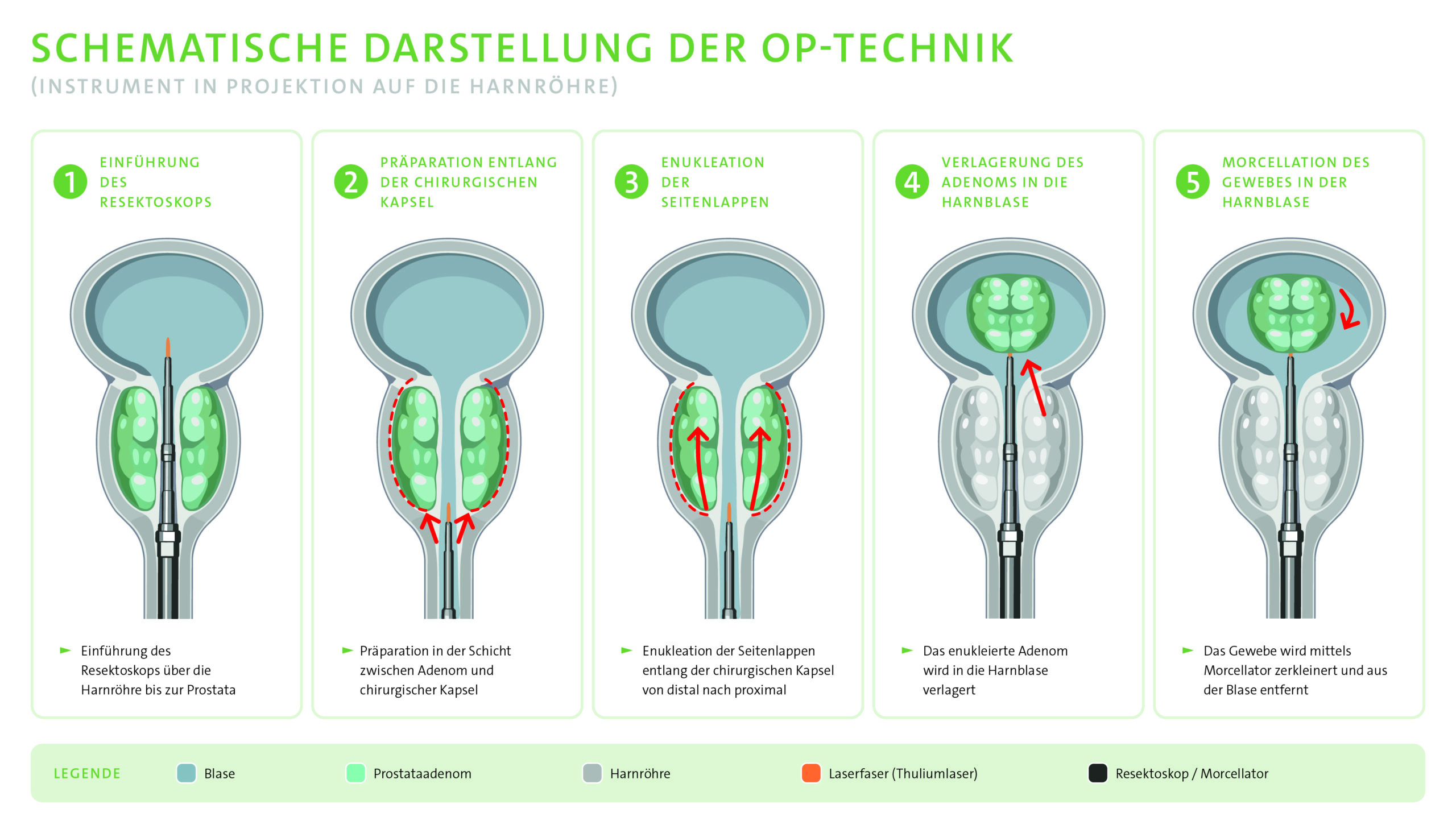 Schematische Darstellung der OP-Technik ThuLEP, die zeigt, wie das Resektops über die Harnröhre in die Prostata eingeführt wird, um das enukleierte Adenom in die Harnröhre zu verlagern. Dort wird es mittels Morcellator zerkleinert und aus der Harnblase entfernt.